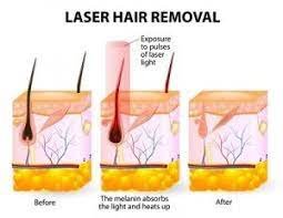 Everything you need to know about IPL Hair Removal - Body laser clinic