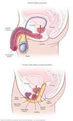 Anatomy before and after penile inversion - Mayo Clinic